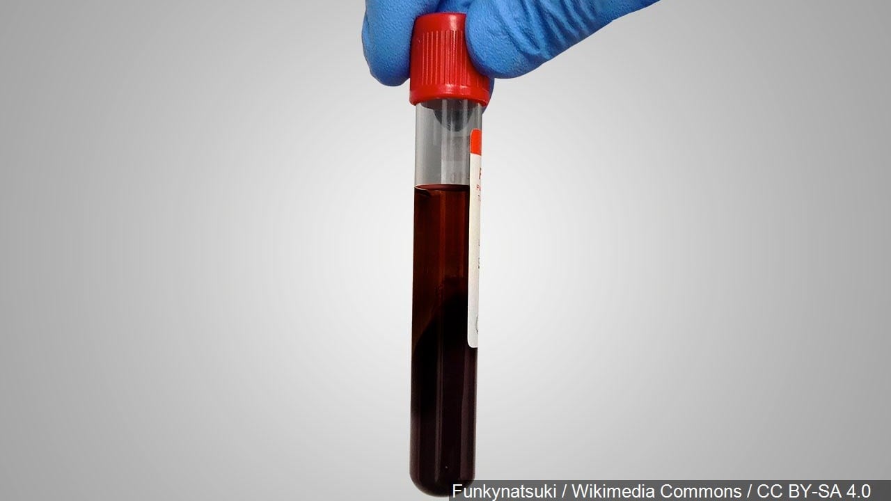 UK piloting blood tests that may detect 50 types of cancer