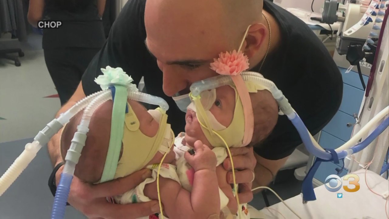 How are the Altobelli conjoined twins doing today? All the details 